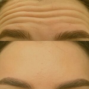 Toxina Botulínica (BOTOX)