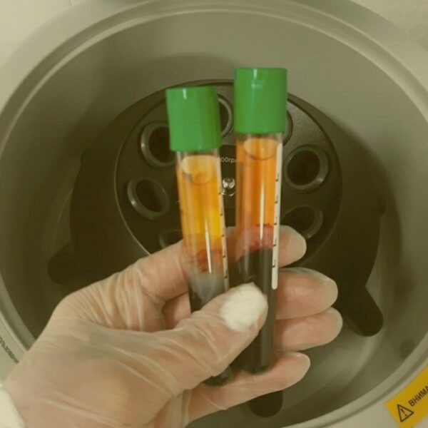Plasma Rico en Plaquetas (PRP)