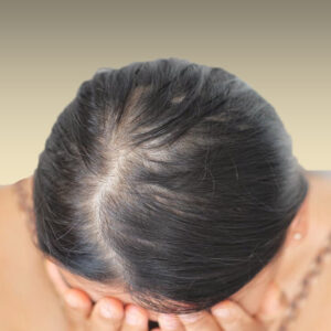 Tratamiento Alopecia (1 Sesión)