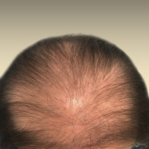 Tratamiento Alopecia (3 sesiones)