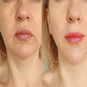 Rejuvenecimiento Facial (3 Sesiones)