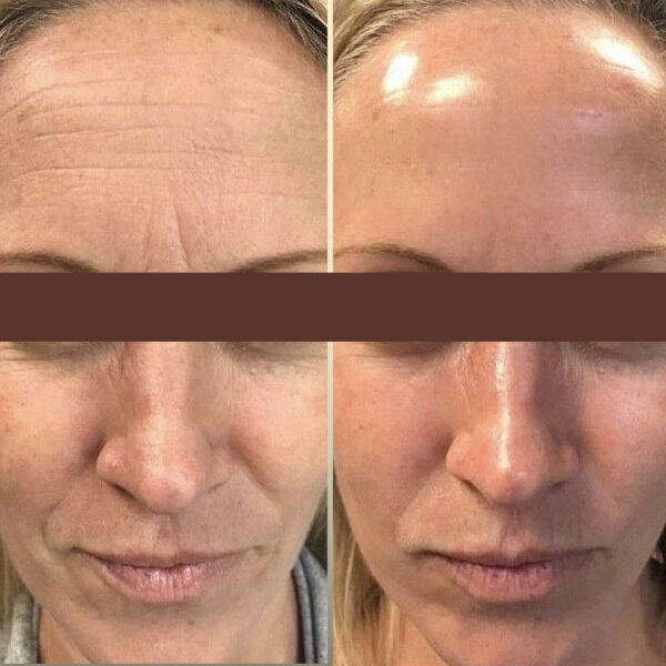 Tratamiento Rejuvenecimiento Facial (1 Sesión)